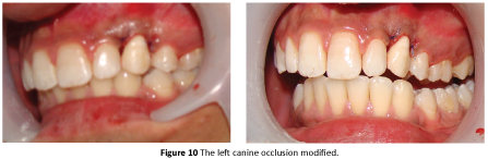 periodontics-prosthodontics-left-canine-occlusion
