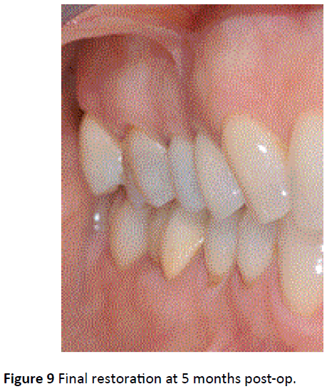 periodontics-prosthodontics-months-post-op
