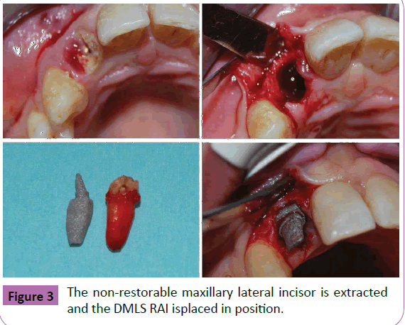 periodontics-prosthodontics-non-restorable-maxillary