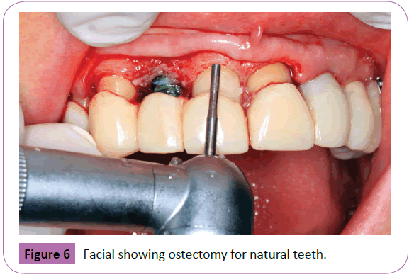 periodontics-prosthodontics-ostectomy-natural-teeth