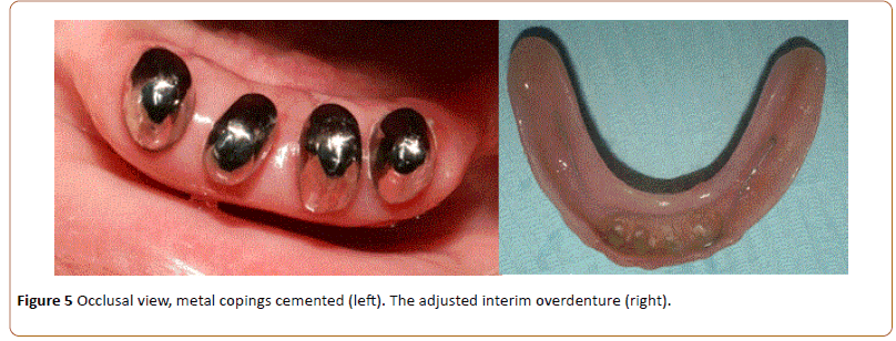 periodontics-prosthodontics-overdenture