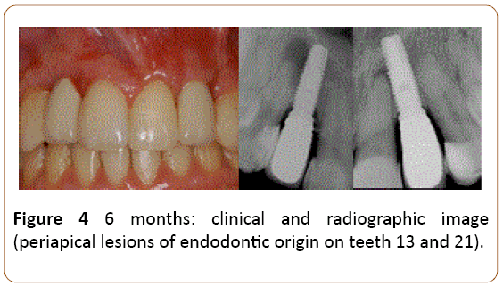 periodontics-prosthodontics-periapical-lesions