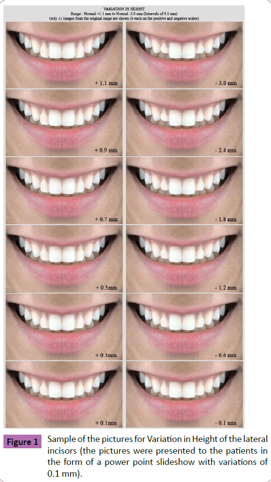 periodontics-prosthodontics-pictures-Variation-Height