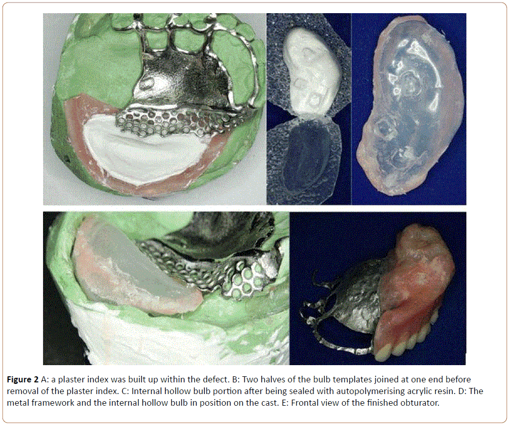 periodontics-prosthodontics-plaster-index