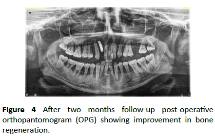 periodontics-prosthodontics-post-operative