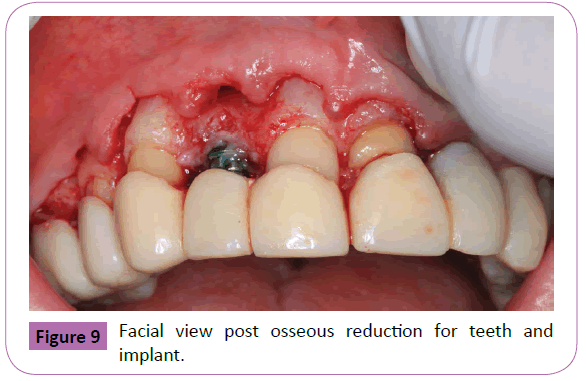 periodontics-prosthodontics-post-osseous-reduction