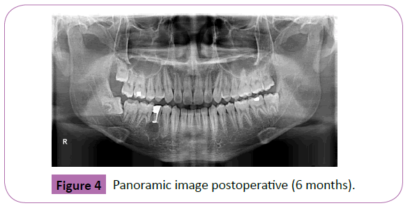 periodontics-prosthodontics-postoperative