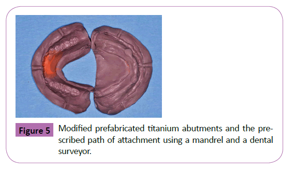 periodontics-prosthodontics-prefabricated-titanium