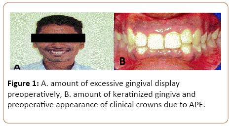 periodontics-prosthodontics-preoperative-appearance