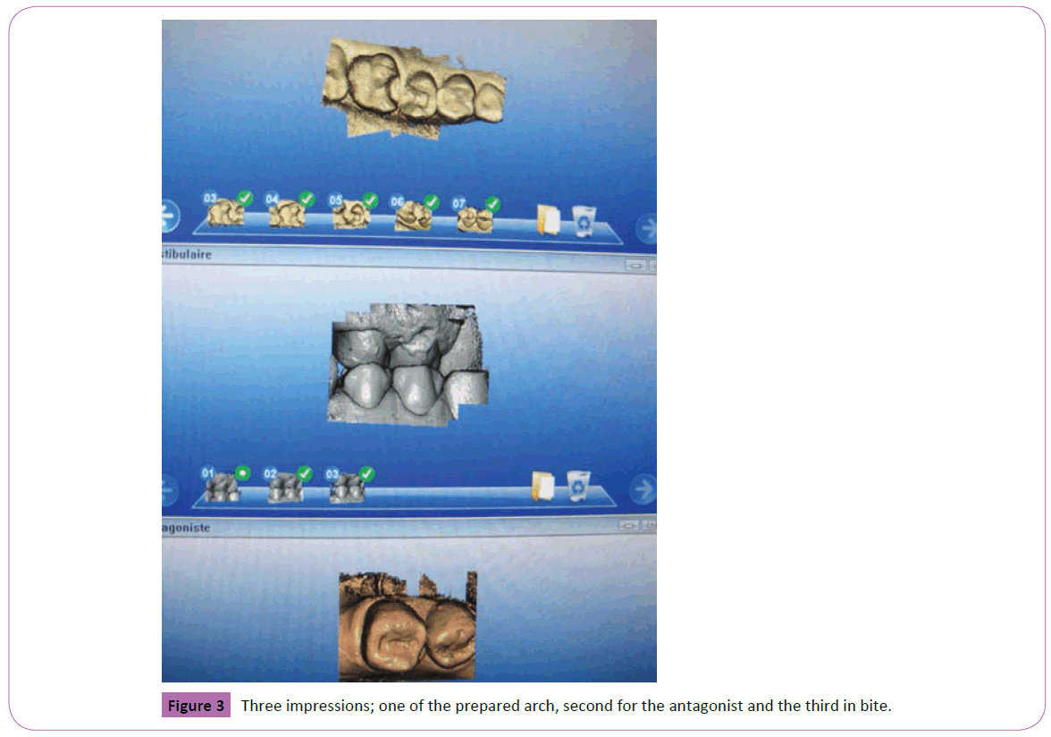 periodontics-prosthodontics-prepared-arch