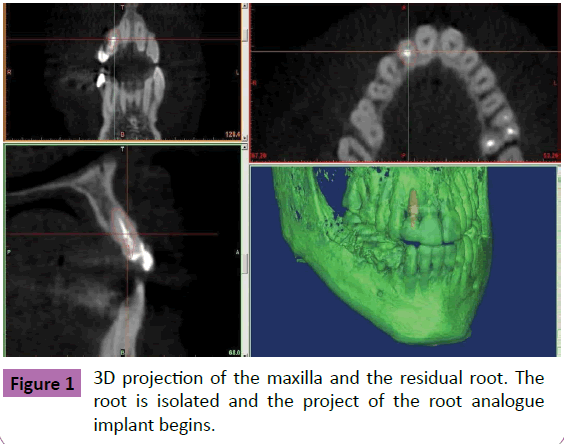 periodontics-prosthodontics-projection-maxilla