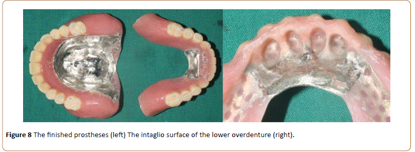 periodontics-prosthodontics-prostheses