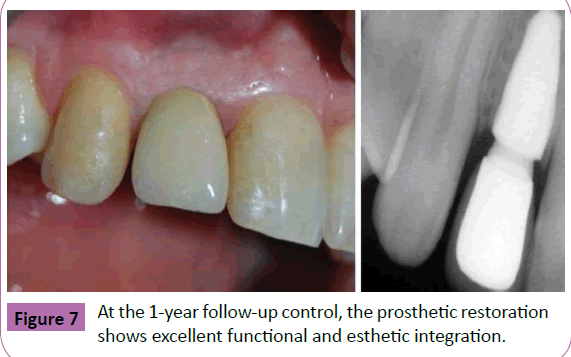 periodontics-prosthodontics-prosthetic-restoration