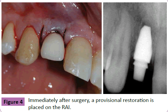 periodontics-prosthodontics-provisional-restoration