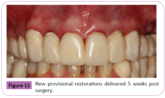 periodontics-prosthodontics-provisional-restorations-delivered