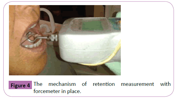 periodontics-prosthodontics-retention-measurement