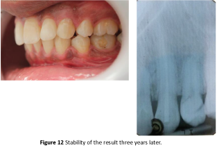 periodontics-prosthodontics-stability-three-years