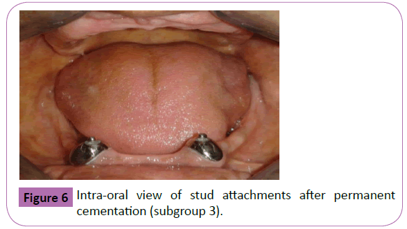 periodontics-prosthodontics-stud-attachments