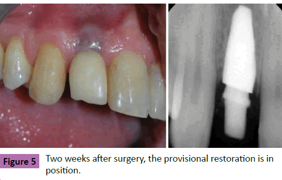 periodontics-prosthodontics-surgery-provisional