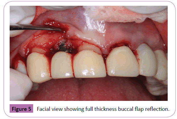 periodontics-prosthodontics-thickness-buccal-reflection