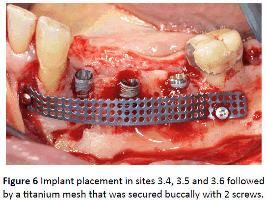 periodontics-prosthodontics-titanium-mesh