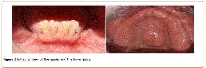 periodontics-prosthodontics-upper