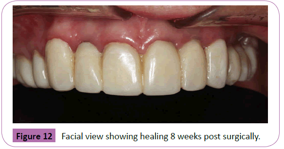 periodontics-prosthodontics-weeks-post-surgically