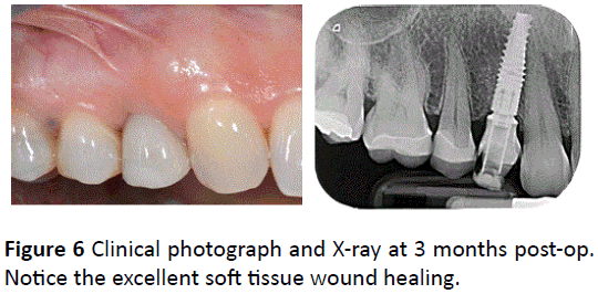 periodontics-prosthodontics-wound-healing