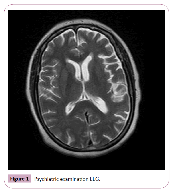 psychopathology-examination-EEG