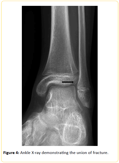 trauma-acute-care-Ankle-X-ray