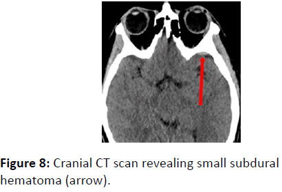 trauma-acute-care-Cranial-CT-scan