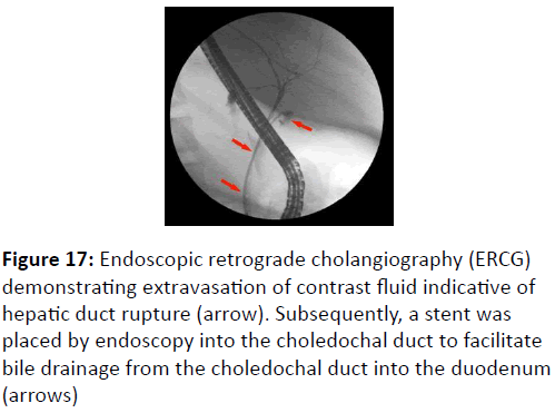 trauma-acute-care-Endoscopic-retrograde