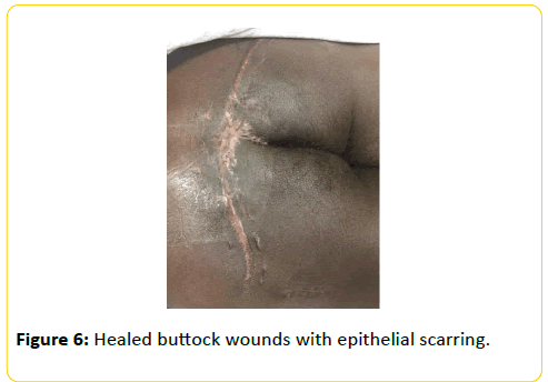 trauma-acute-care-Healed-buttock