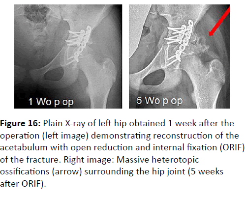 trauma-acute-care-Massive-heterotopic