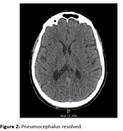 trauma-acute-care-Pneumocephalus-resolved