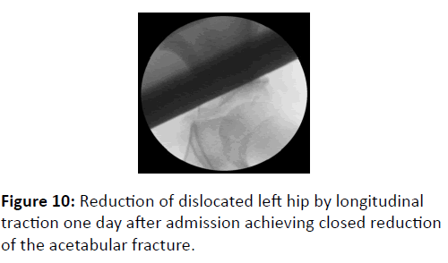 trauma-acute-care-Reduction-of-dislocated