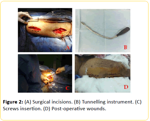 trauma-acute-care-Screws-insertion