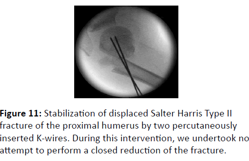 trauma-acute-care-Stabilization-of-displaced