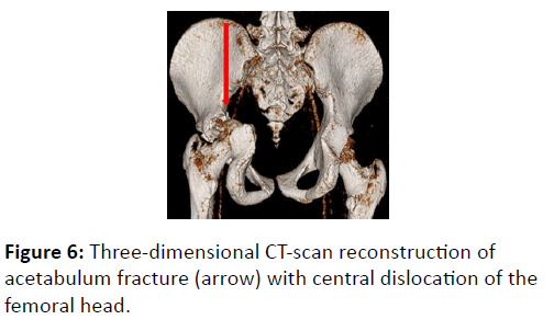 trauma-acute-care-acetabulum-fracture