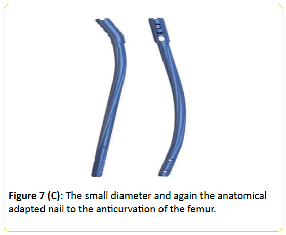 trauma-acute-care-adapted-nail-anticurvation-femur