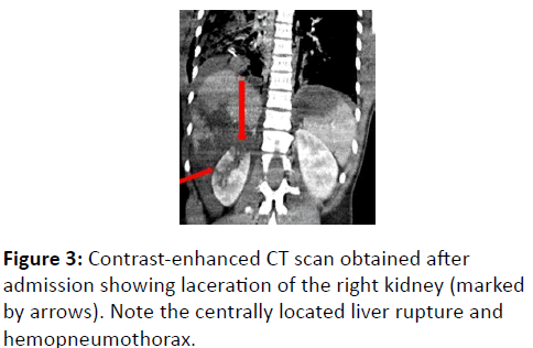 trauma-acute-care-admission-showing-laceration-CT