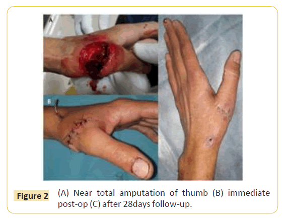 trauma-acute-care-amputation