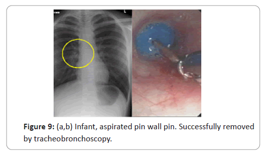 trauma-acute-care-aspirated