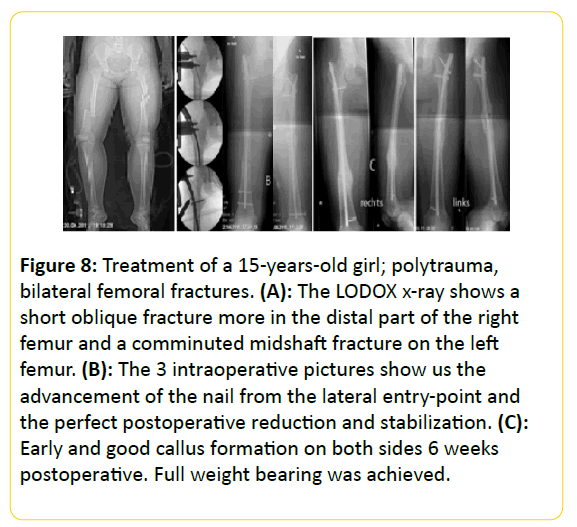 trauma-acute-care-bilateral-femoral-fractures