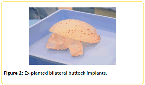 trauma-acute-care-buttock-implants