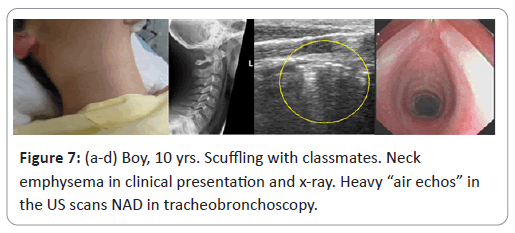 trauma-acute-care-emphysema