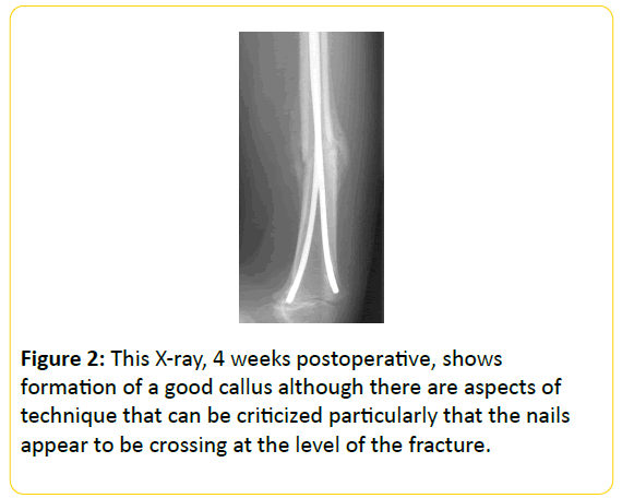 trauma-acute-care-formation-good-callus