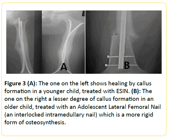 Reverse wedge effect following intramedullary nail fixation of trochanteric  fracture, what does it imply? | BMC Musculoskeletal Disorders | Full Text