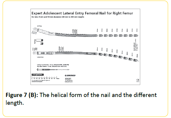 trauma-acute-care-helical-form-nail