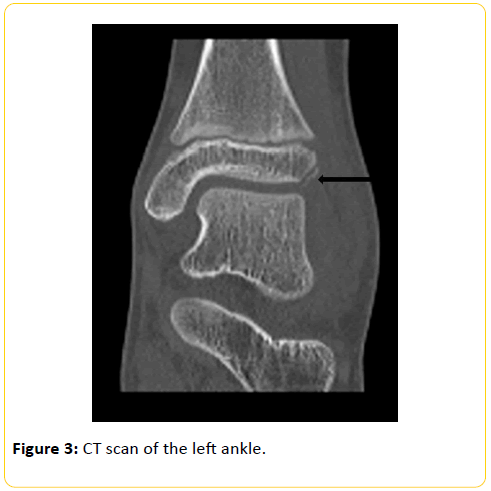 trauma-acute-care-left-ankle